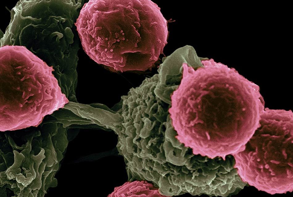 Peste 1 milion de cazuri de cancer nediagnosticate în Europa din cauza pandemiei